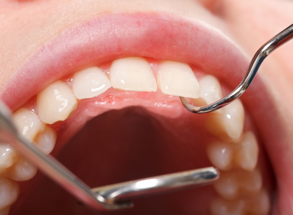 Closeup of a set of teeth at the dentist