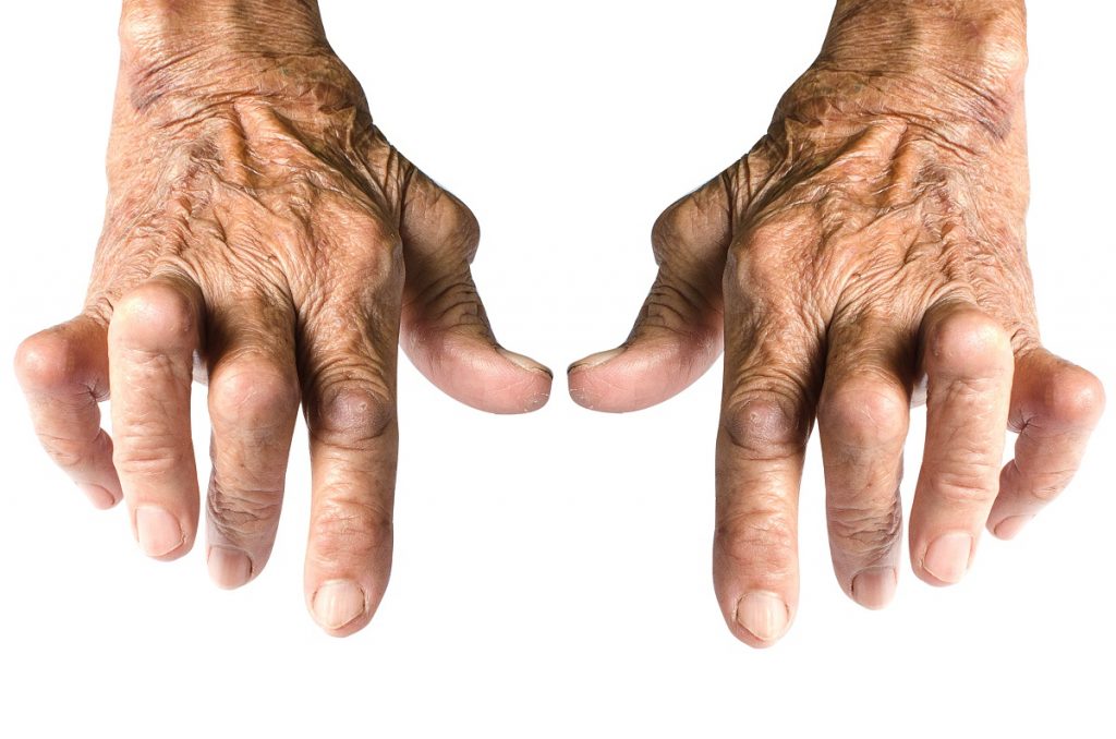 Deformed hand due to rheumatoid arthritis