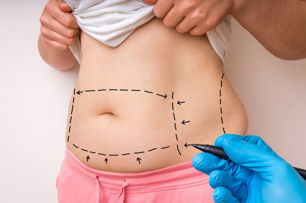 Plastic surgery drawing on a tummy