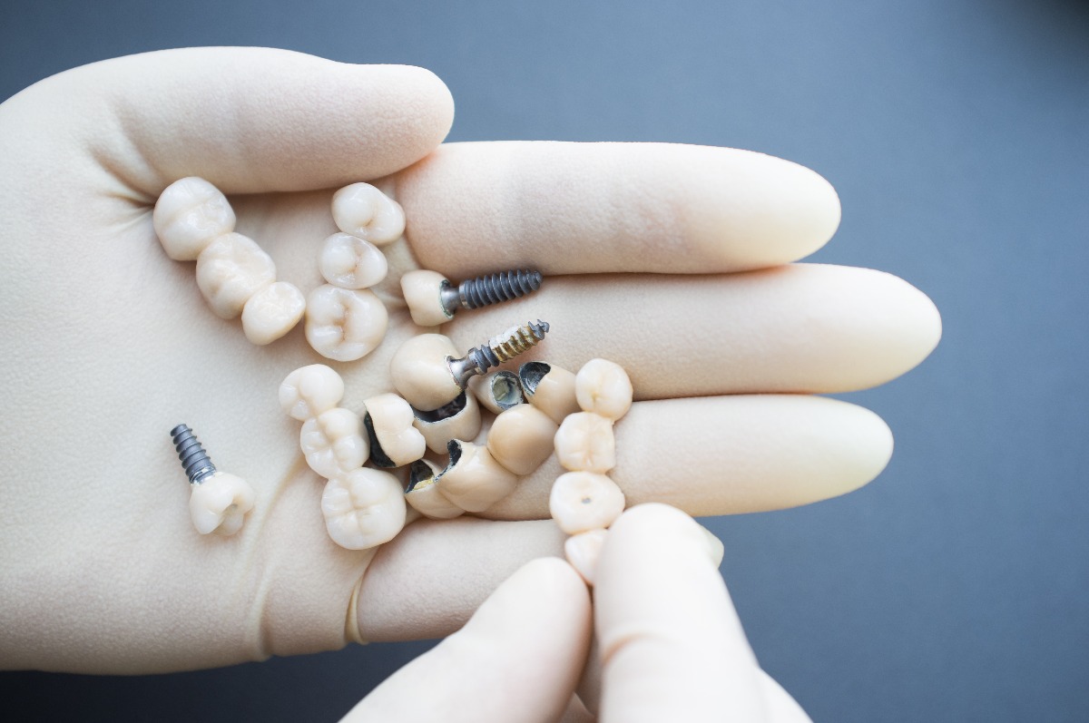 dental implants