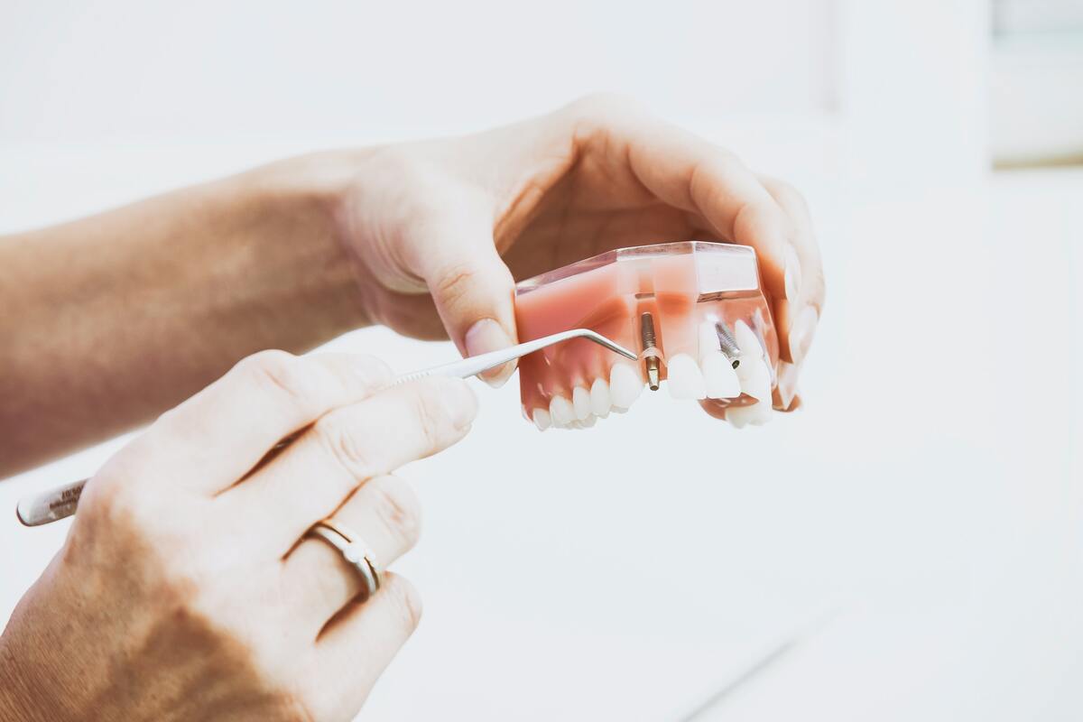 oral implant model